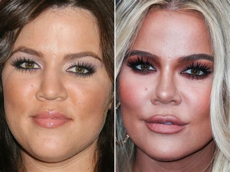 chloe before surgery|khloe kardashian before and after.